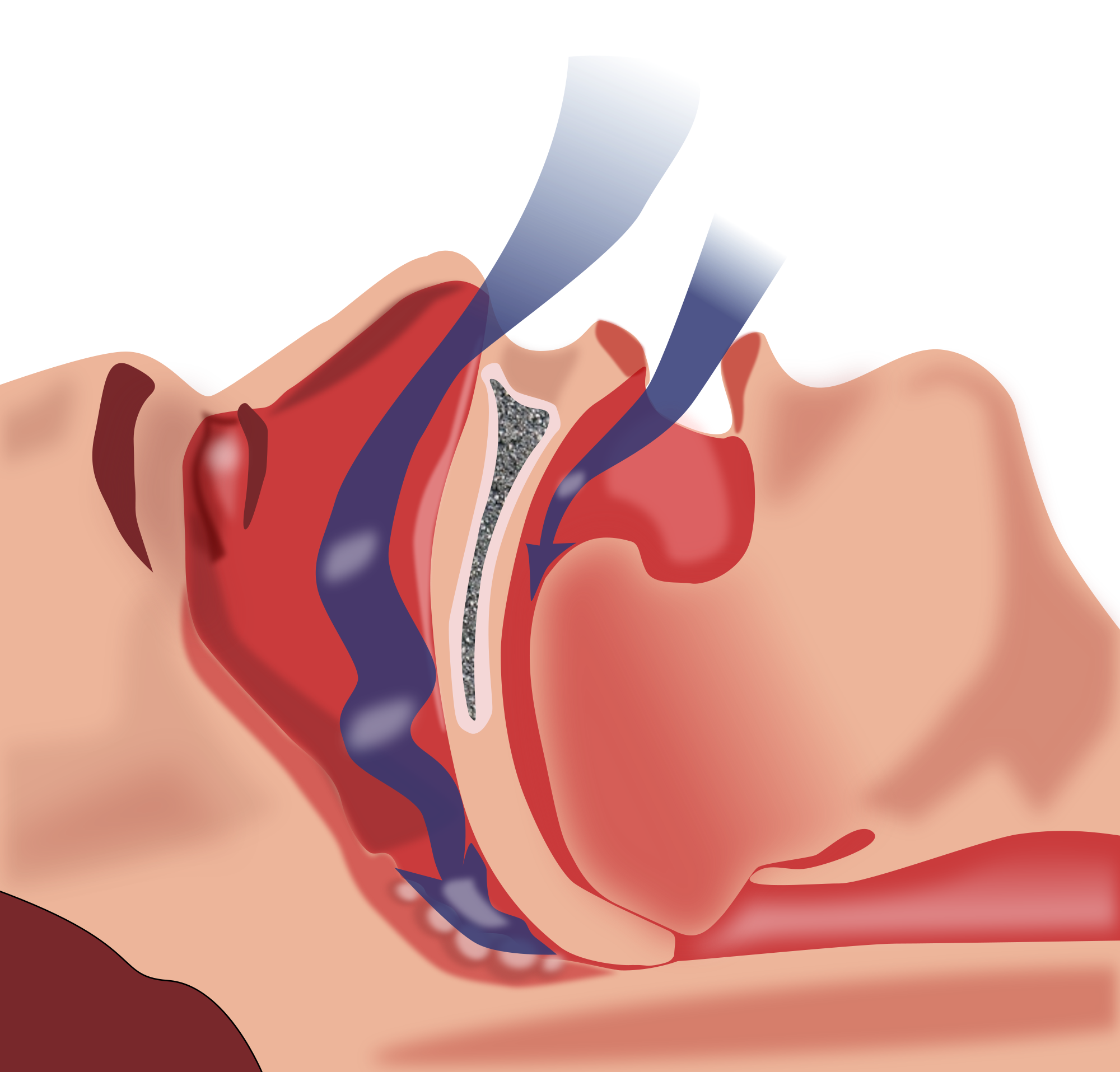 Возможна кратковременная задержка апноэ, состояние опасно тем, что протекает незаметно для человека, когда он спит, обычно при длительной задержке дыхания (на 1 – 2 минуты) центральная нервная система (ЦНС) дает сигнал к просыпанию, но иногда что-то может не сработать, от длительного кислородного голодания пострадают жизненно важные центры (дыхательный, сосудодвигательный), апноэ во время сна может привести к гибели человека