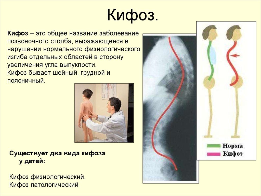 Причины развития кифоза грудного отдела позвоночника