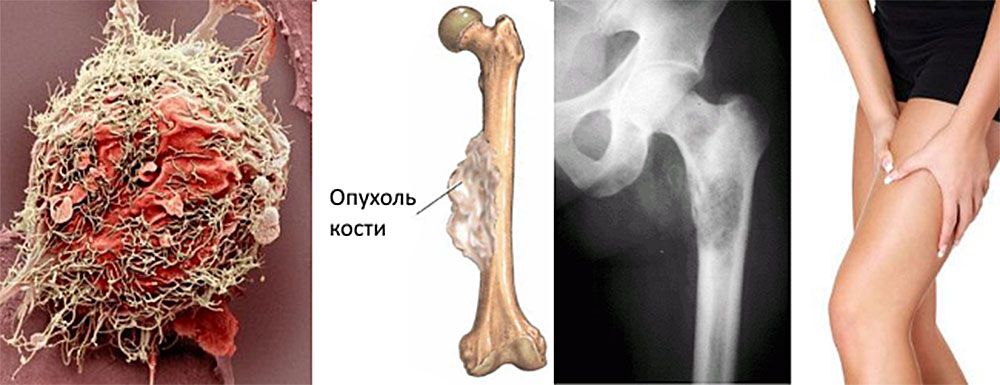 Диагностика энхондромы бедренной кости, последствия и профилактика