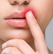 Заеды в уголках рта: причины и лечение у взрослых