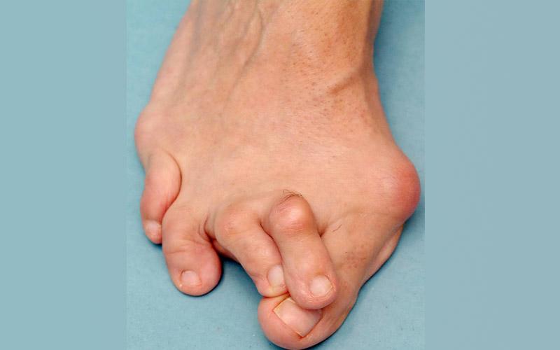 Лечение деформации молоткообразных пальцев на ногах