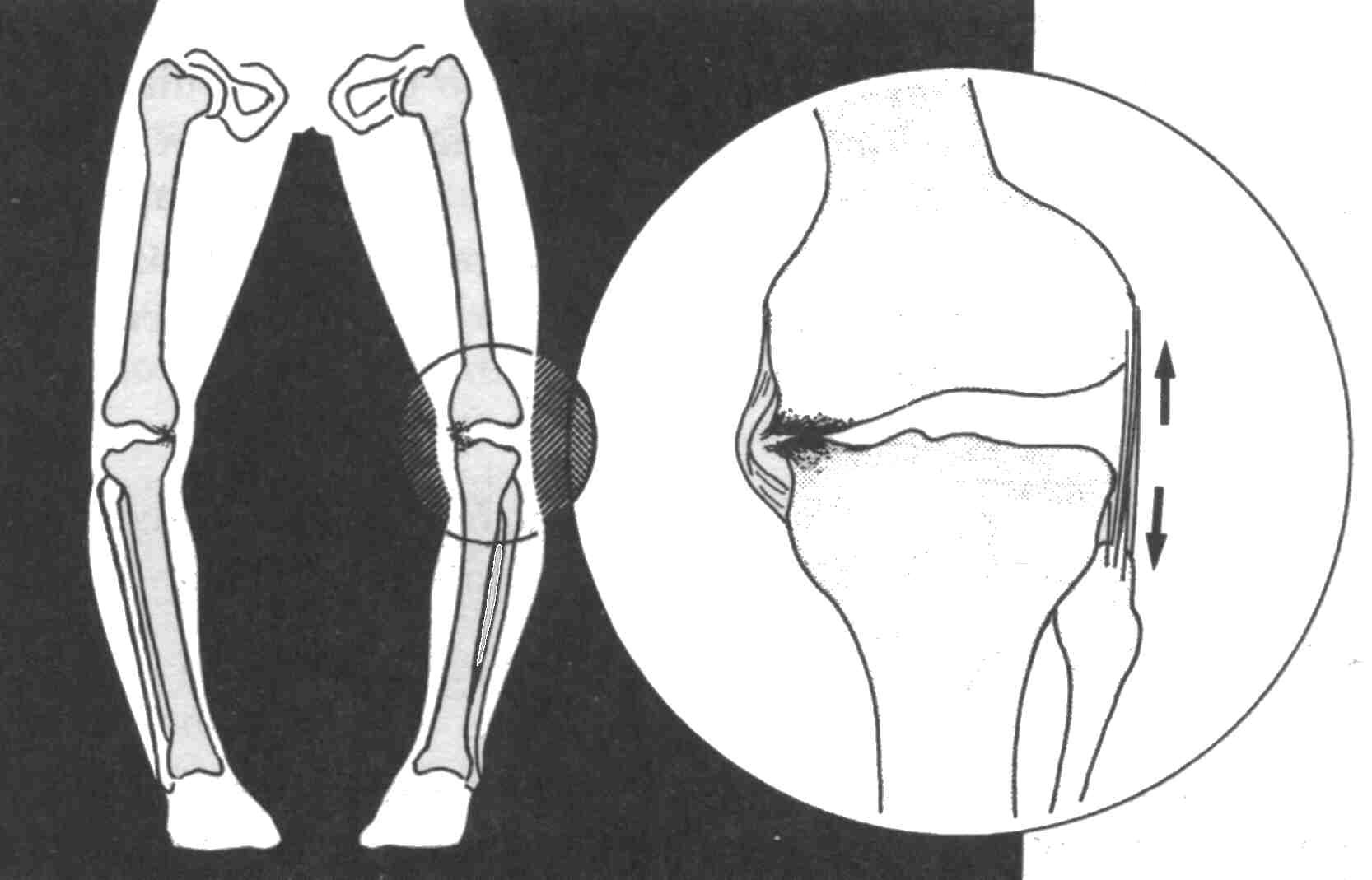 Патология нижних конечностей дисплазия коленного сустава