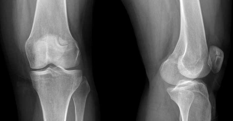 Патология нижних конечностей дисплазия коленного сустава