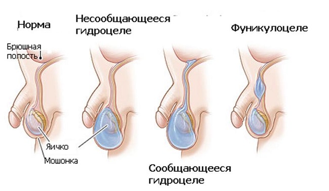 Водянка яичка (гидроцеле): причины и лечение