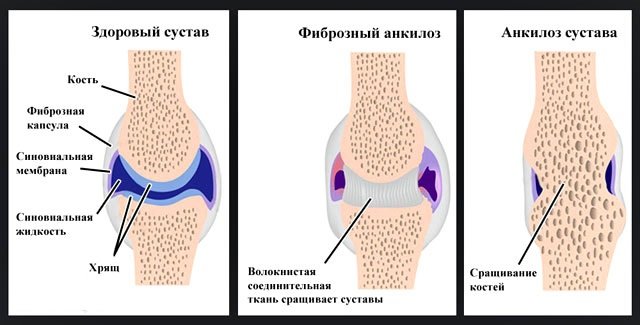 Признаки и стадии ревматоидного артрита на рентгене и МРТ
