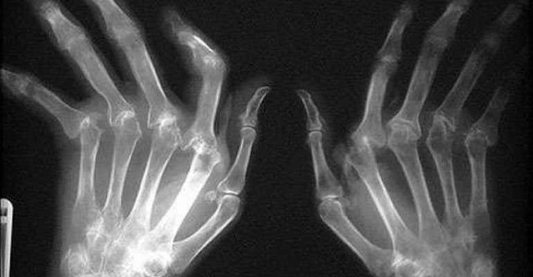 Признаки и стадии ревматоидного артрита на рентгене и МРТ