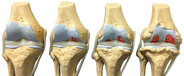 Все плюсы и минусы лазеротерапии при артрозе коленного сустава