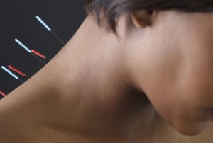 Эффективность применения иглотерапии при остеохондрозе шейного отдела позвоночника