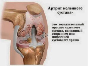 Из-за чего появляется боль с внутренней стороны сбоку колена и как от нее избавиться