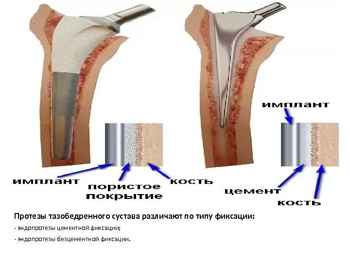 Процесс реабилитации после перелома шейки бедра и эндопротезирования тазобедренного сустава