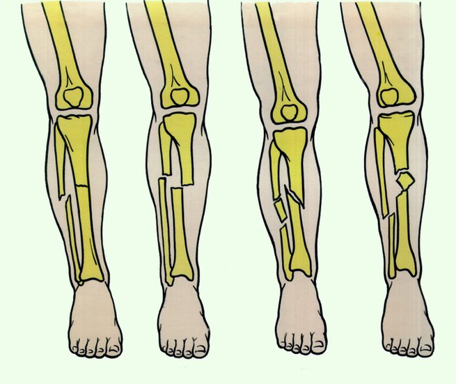 Причины возникновения боли в ногах от колена до ступни
