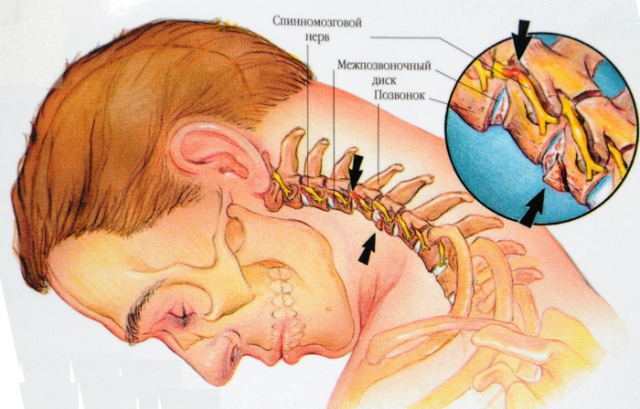 Характерные симптомы и лечение остеохондроза шейного отдела позвоночника
