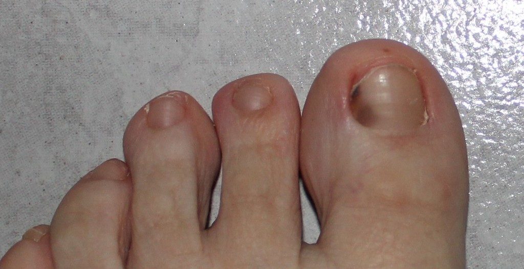 Потемнели ногти на больших пальцах ног что это такое и как лечить