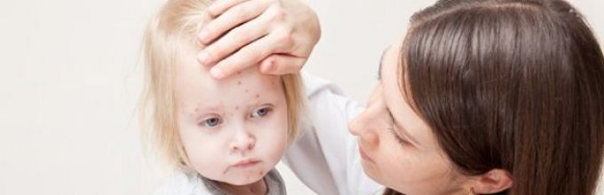 Как правильно лечить себорею у детей на голове