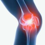 Основные причины появления грыж коленного сустава
