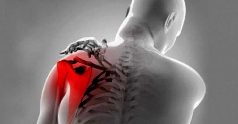 Методы лечения и профилактики тендинита плечевого сустава