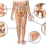 Причины развития артроза 4 степени коленного сустава