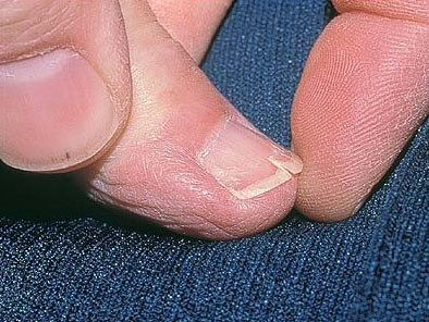 Трещины на ногтях рук появляются по причине частого контакта с бытовой химией