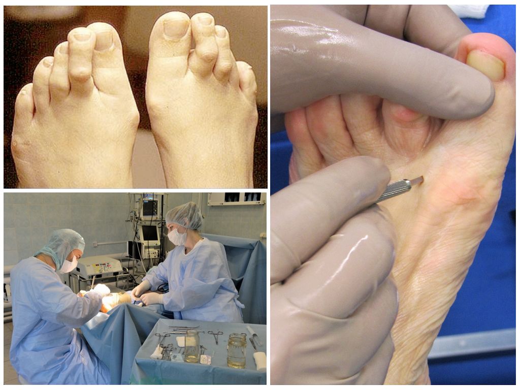 Лечение деформации молоткообразных пальцев на ногах