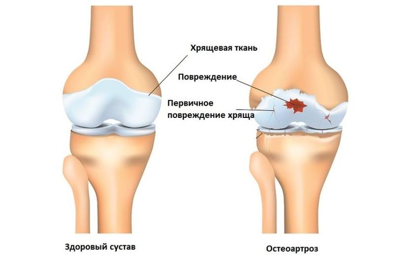 Методы лечения артроза коленного сустава