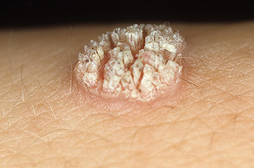 Папиллома - это нарост на коже, вызванный ВПЧ