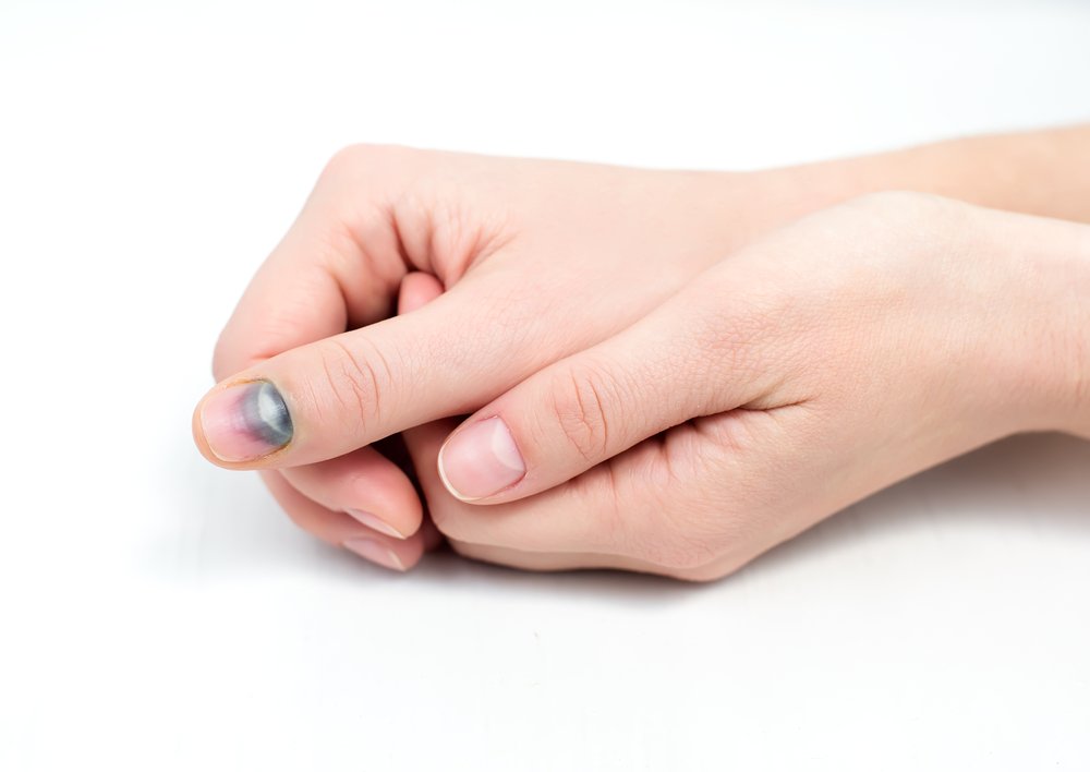 Как не допустить осложнений после ушиба пальца на руке