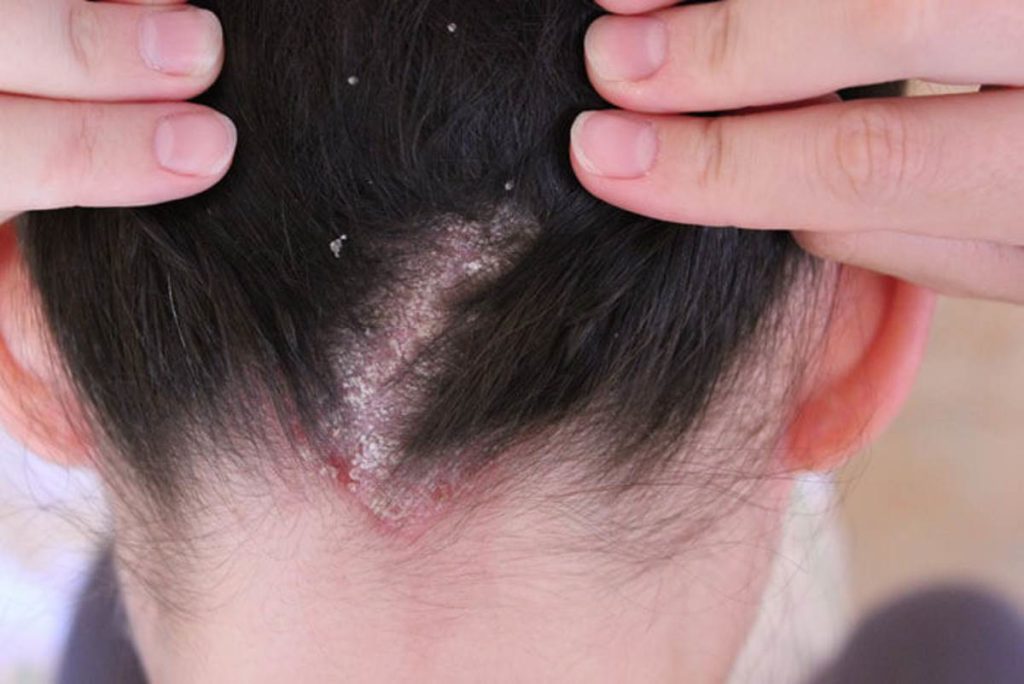 Какие существуют лекарства для лечения псориаза волосистой части головы
