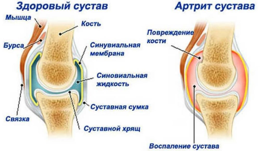 Комплекс эффективных упражнений при артрите коленного сустава