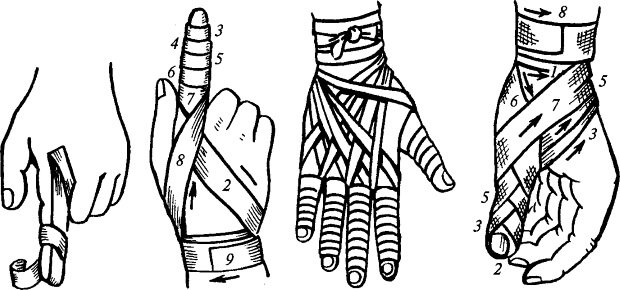 Виды лучших повязок для фиксации руки при переломе