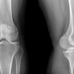 Причины развития артроза 4 степени коленного сустава
