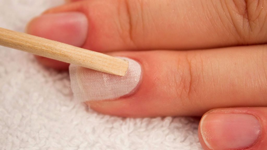 Почему появились трещины на ногтях рук фото, причины и лечение
