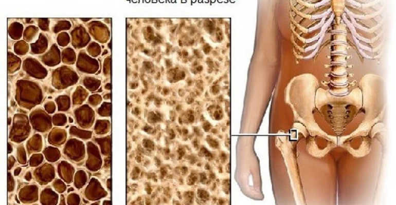 Симптомы и лечение заболевания костей остеопороза