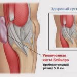 Основные симптомы и методы лечения бурсита коленного сустава