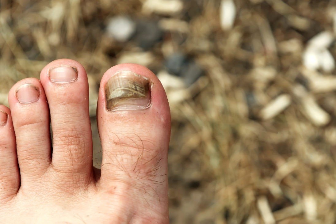 Почернение ногтя вызывает травма