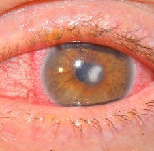 Кератит глаза: фото, симптомы и лечение
