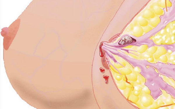 Внутрипротоковая папиллома молочной железы