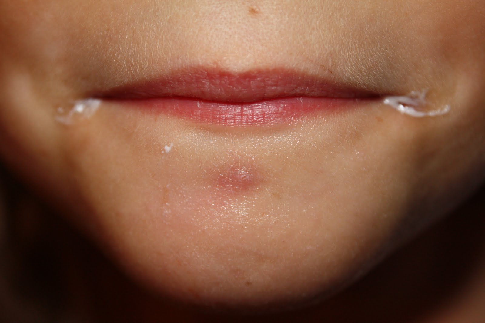 аллергия вокруг рта фото