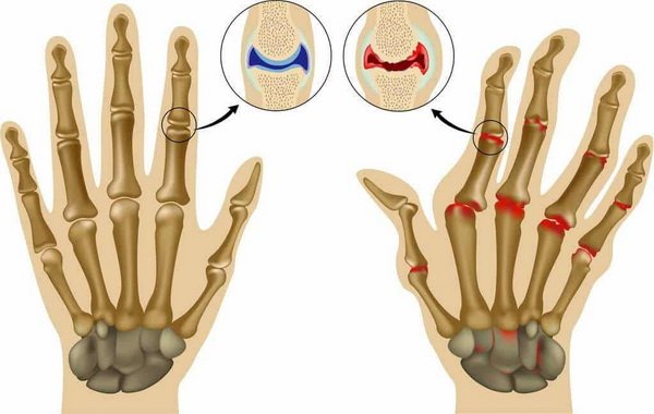 Причины и симптомы возникновения артрита пальцев рук