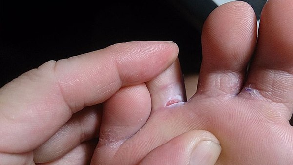 Часто трещины на пальцах ног возникают из-за трения