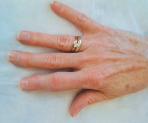 Как не допустить осложнений после ушиба пальца на руке