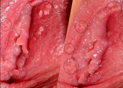 Папилломы на половых губах вызываются ВПЧ