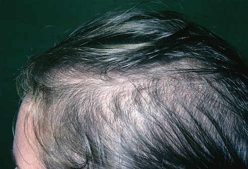 Трихология лечение выпадения волос