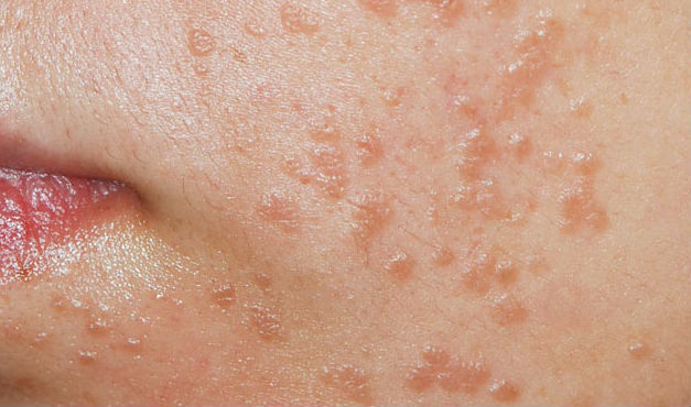 Плоскоклеточная папиллома может появиться на любом месте кожи
