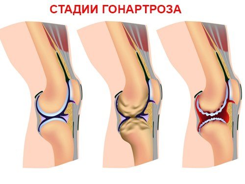 Диагностика и профилактика двустороннего гонартроза коленного сустава