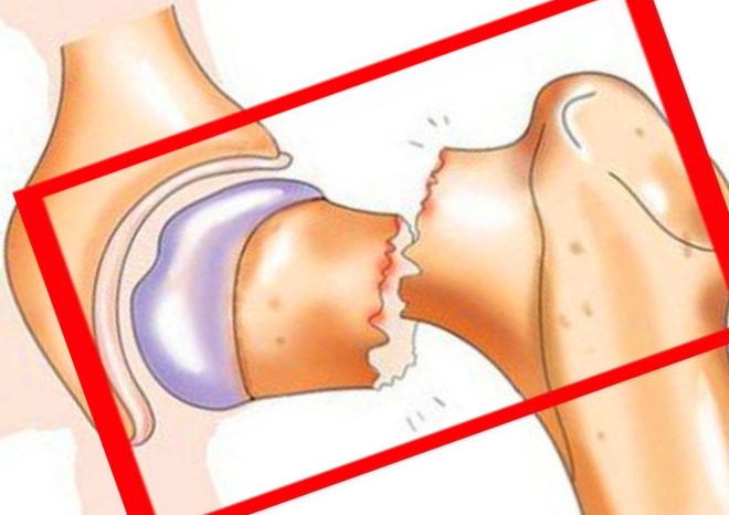Симптомы шейки бедра как определить. Вколоченный перелом тазобедренного сустава. Вколоченный перелом шейки бедренной кости. Шейка бедра перелом вколоченный. Вколоченный перелом шейки бедра.