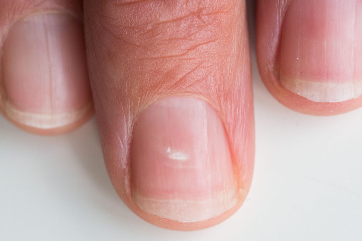 Белое пятно на ногте может означать проблемы в работе организма