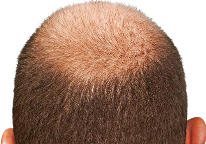 Выпадают волосы у мужчины какие средства помогут остановить проблему
