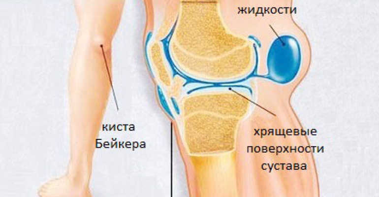 Основные причины появления грыж коленного сустава