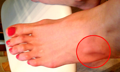 Шишка на ноге под кожей бывает вызвана разными причинами
