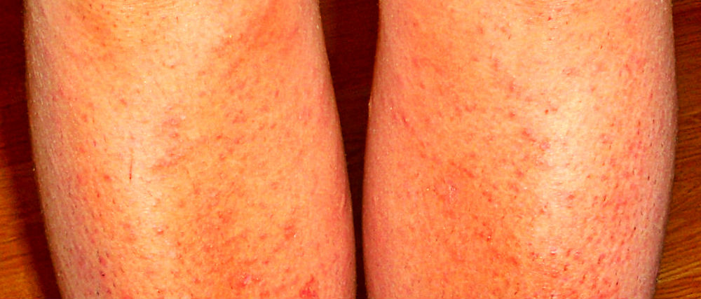 Красные точки на голени ног что это такое, причины, фото, лечение